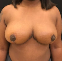 Breast Reduction