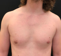 Gynecomastia