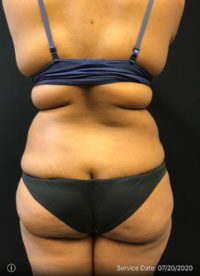 Liposuction