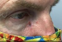 Basal Cell Carcinoma