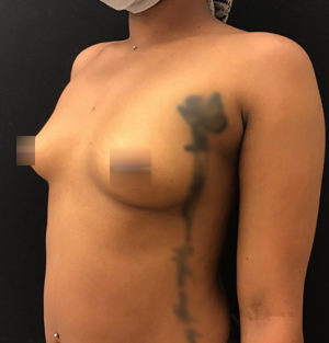 Breast Augmentation