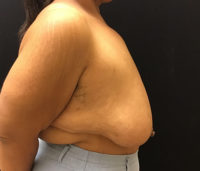 Breast Reduction