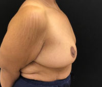 Breast Reduction