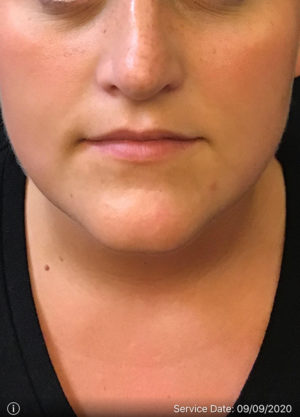 Lip Augmentation