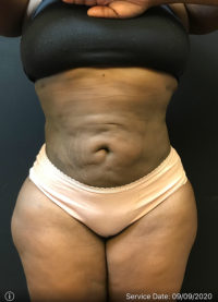Liposuction