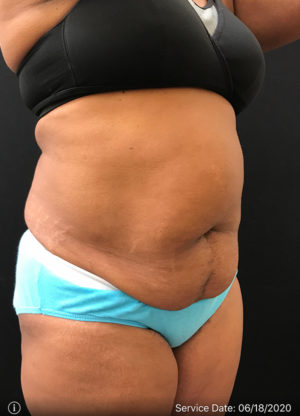 Liposuction