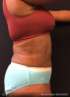 Liposuction