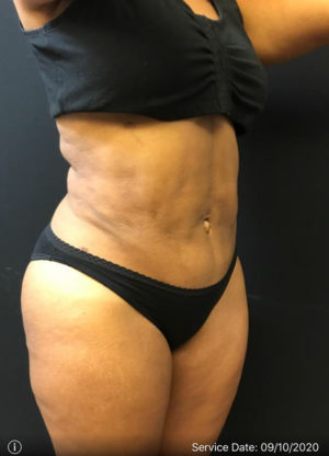 Liposuction