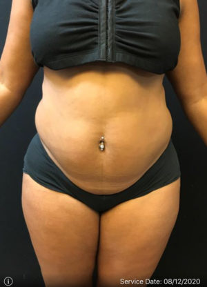 Liposuction
