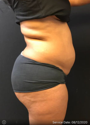 Liposuction