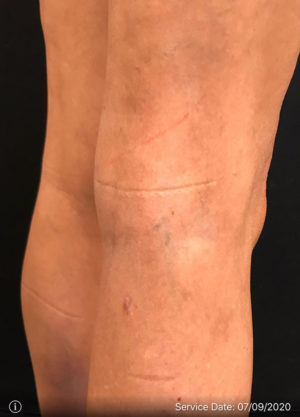 Sclerotherapy