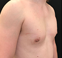 Gynecomastia