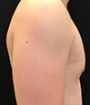 Gynecomastia