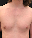 Gynecomastia