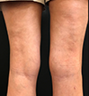 Sclerotherapy