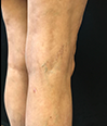 Sclerotherapy