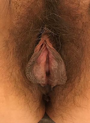 Labiaplasty