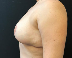 Breast Reduction