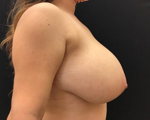 Breast Reduction