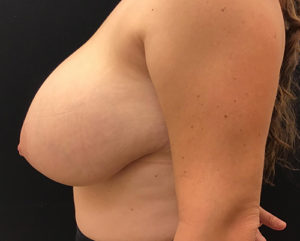 Breast Reduction