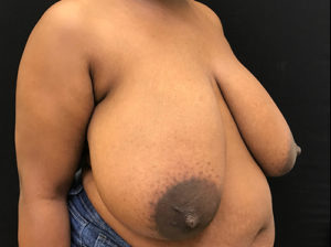 Breast Reduction