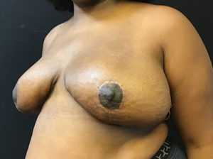 Breast Reduction