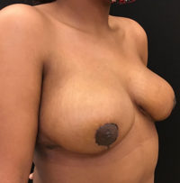 Breast Reduction