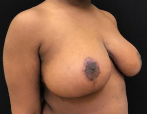 Breast Reduction