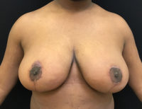 Breast Reduction