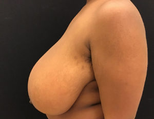 Breast Reduction