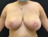 Breast Reduction