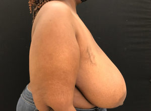 Breast Reduction