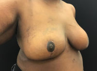 Breast Reduction
