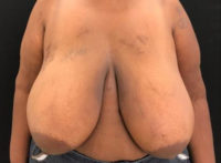 Breast Reduction