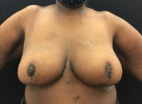 Breast Reduction