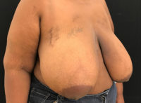 Breast Reduction