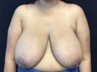 Breast Reduction