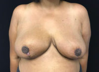 Breast Reduction