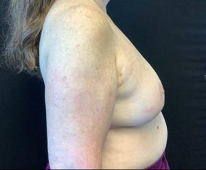 Breast Reduction