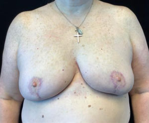 Breast Reduction