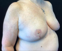 Breast Reduction