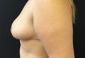 Breast Reduction