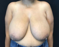 Breast Reduction