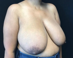 Breast Reduction