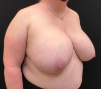 Breast Reduction