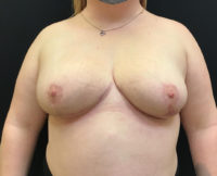 Breast Reduction
