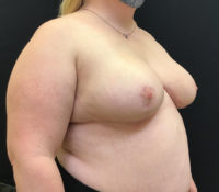 Breast Reduction