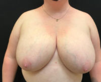 Breast Reduction