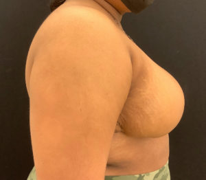 Breast Reduction