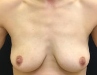 Breast Augmentation